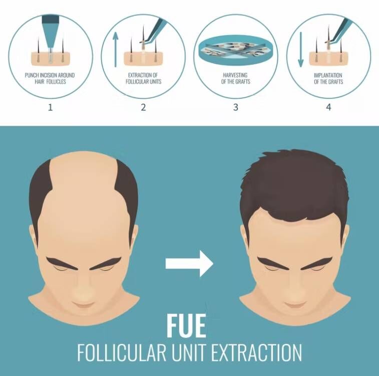 FUE-Micro Motor Máquina De Tra - Hair Care With Protein avaliação e preço